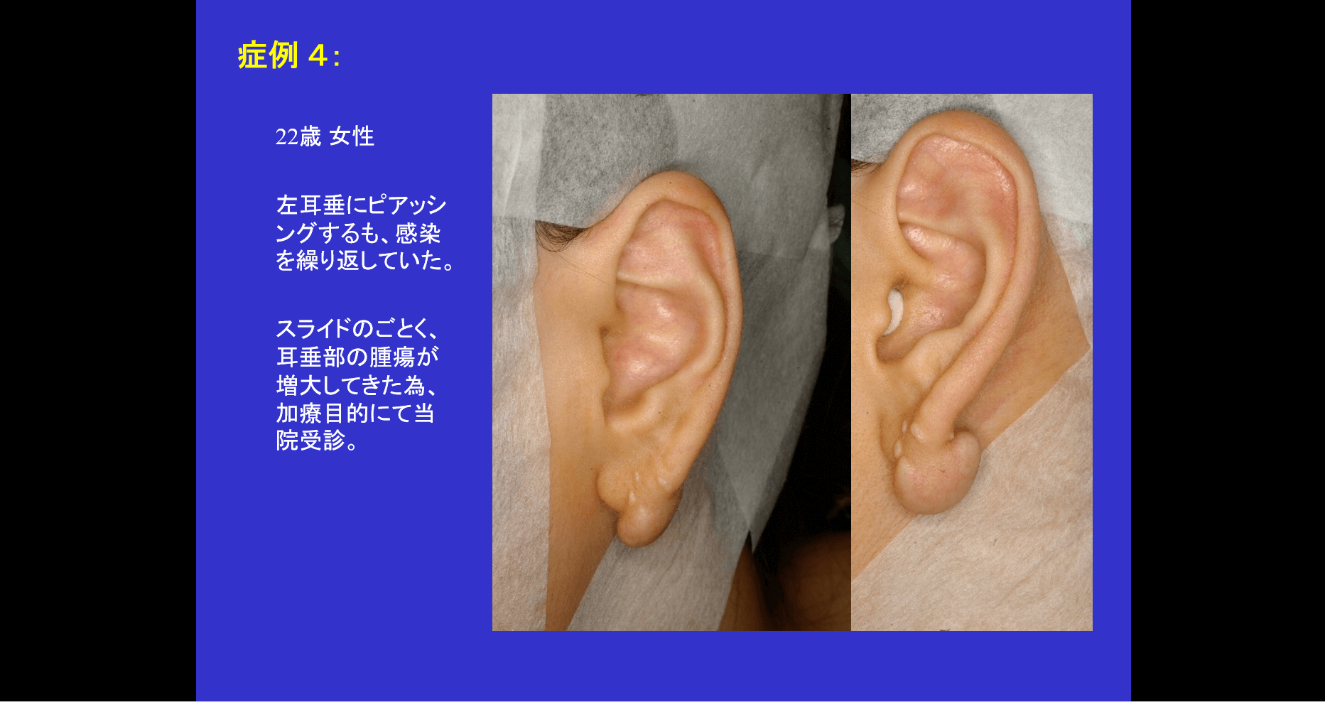 耳のケロイド治療