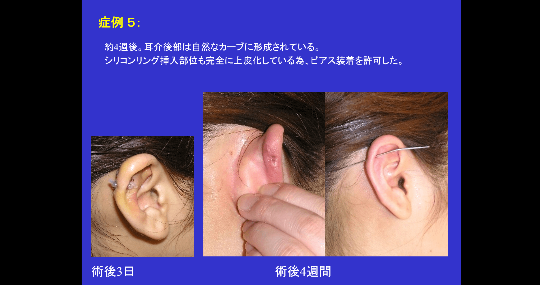 耳のケロイド治療
