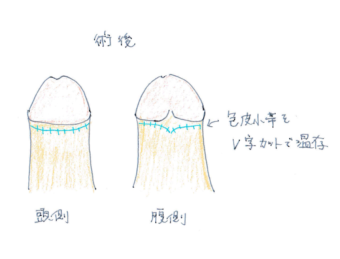 包茎のタイプは３種類