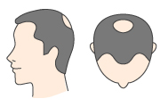 2型の状態に加え、頭頂部がO型に薄くなってきた状態