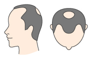 3型の状態に加え、頭頂部がO型に薄くなってきた状態