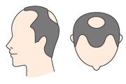 前頭部の生え際が5型よりも後退し、頭頂部もO型に薄くなってきた状態