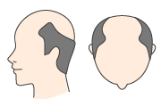 前頭部と頭頂部の薄毛部分が繋がり、発毛部分が側頭部のみの状態