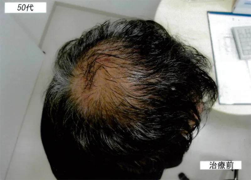 症例1 50代男性 薄毛治療の症例写真 1枚目