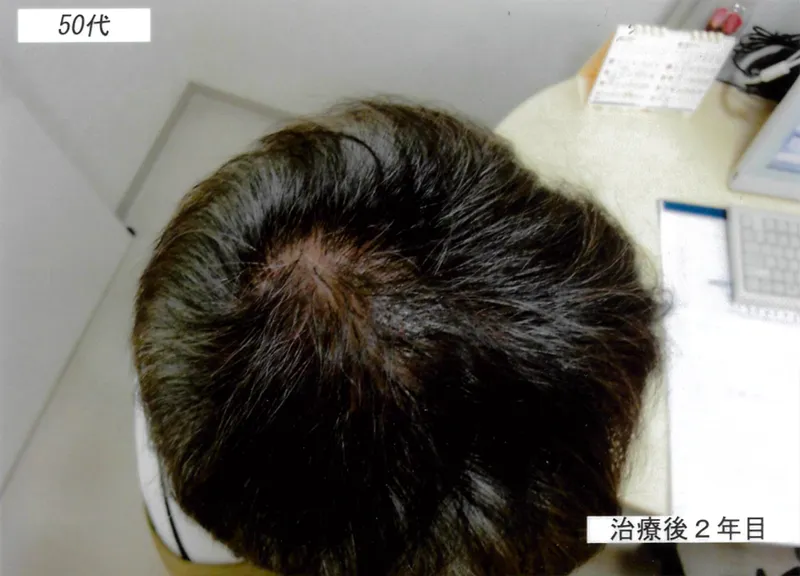 症例1 50代男性 薄毛治療の症例写真 2枚目
