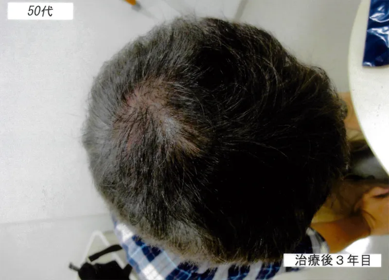 症例1 50代男性 薄毛治療の症例写真 3枚目