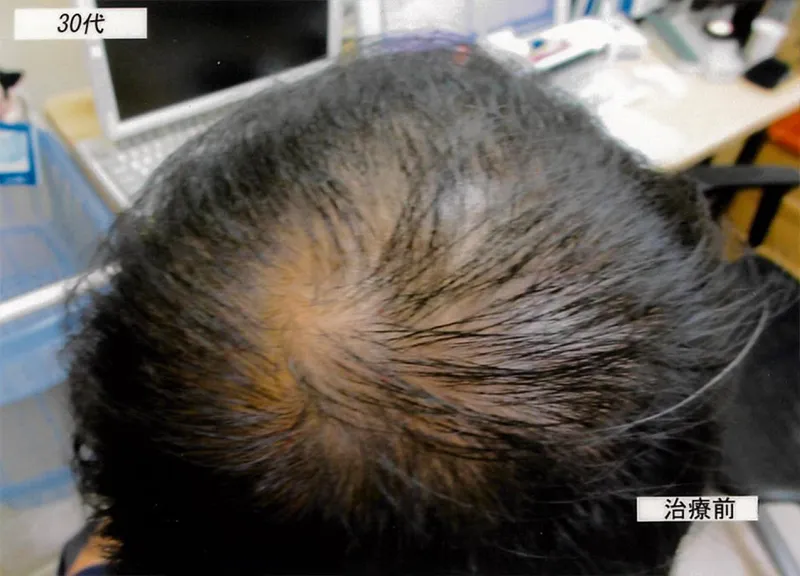 症例2 30代男性 薄毛治療の症例写真 1枚目