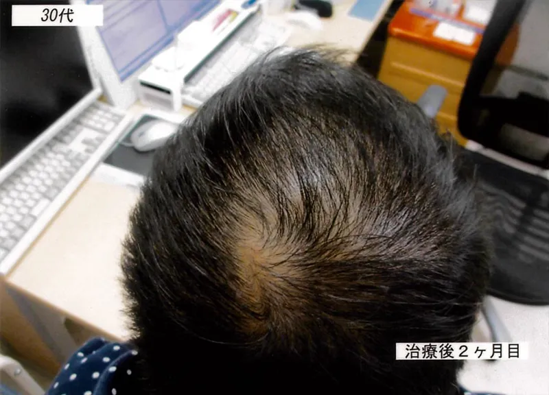 症例2 30代男性 薄毛治療の症例写真 2枚目