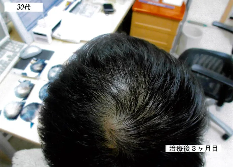 症例2 30代男性 薄毛治療の症例写真 3枚目