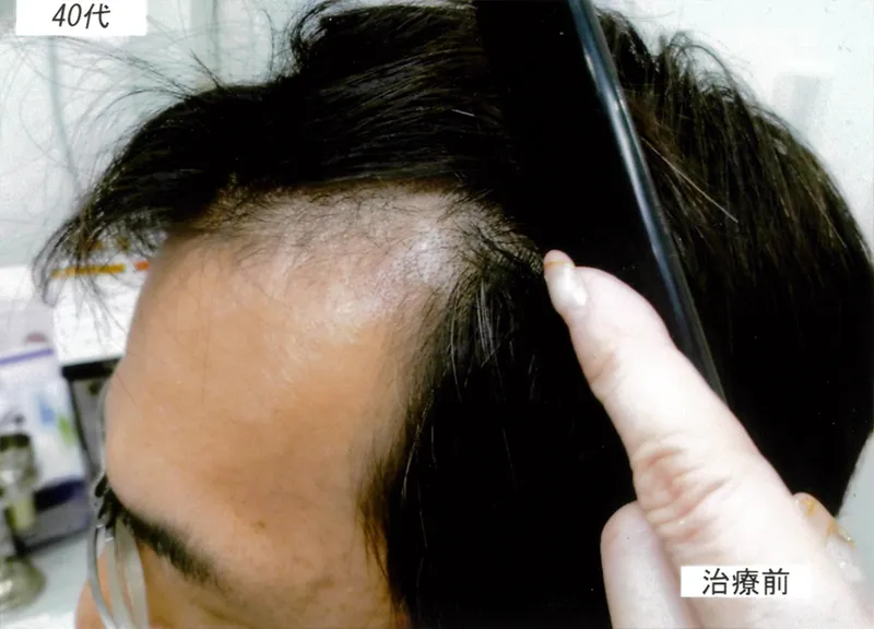 症例3 40代男性 薄毛治療の症例写真 1枚目