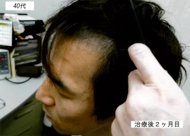 症例3 40代男性 薄毛治療の症例写真 2枚目