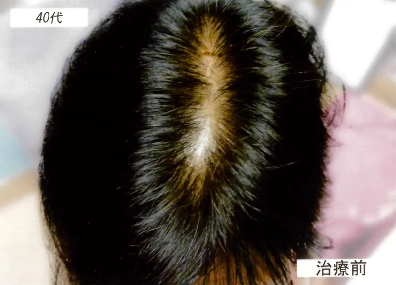 症例4 40代女性 薄毛治療の症例写真 1枚目