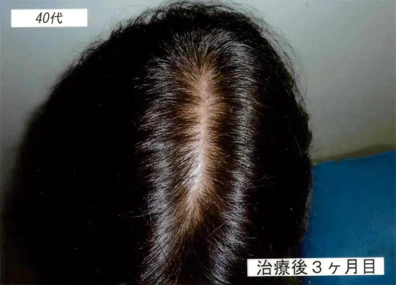 症例4 40代女性 薄毛治療の症例写真 2枚目