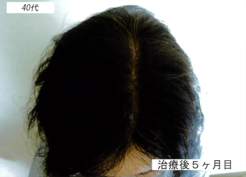 症例4 40代女性 薄毛治療の症例写真 3枚目