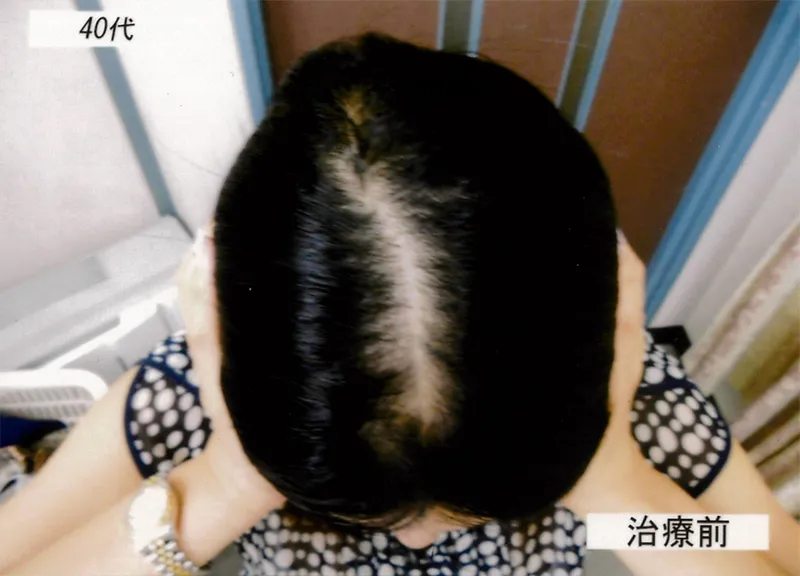 症例5 40代女性 薄毛治療の症例写真 1枚目