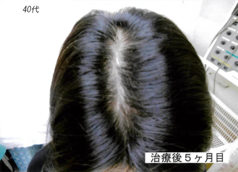 症例5 40代女性 薄毛治療の症例写真 2枚目