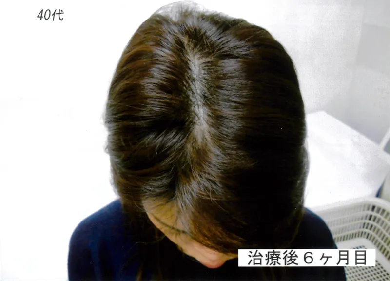 症例5 40代女性 薄毛治療の症例写真 3枚目