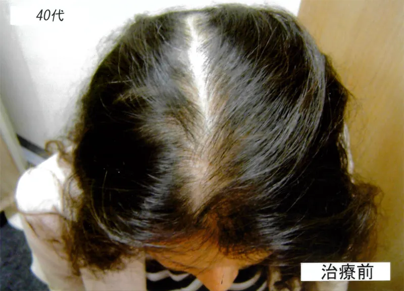 症例6 40代女性 薄毛治療の症例写真 1枚目