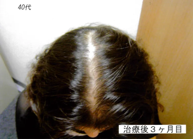 症例6 40代女性 薄毛治療の症例写真 2枚目