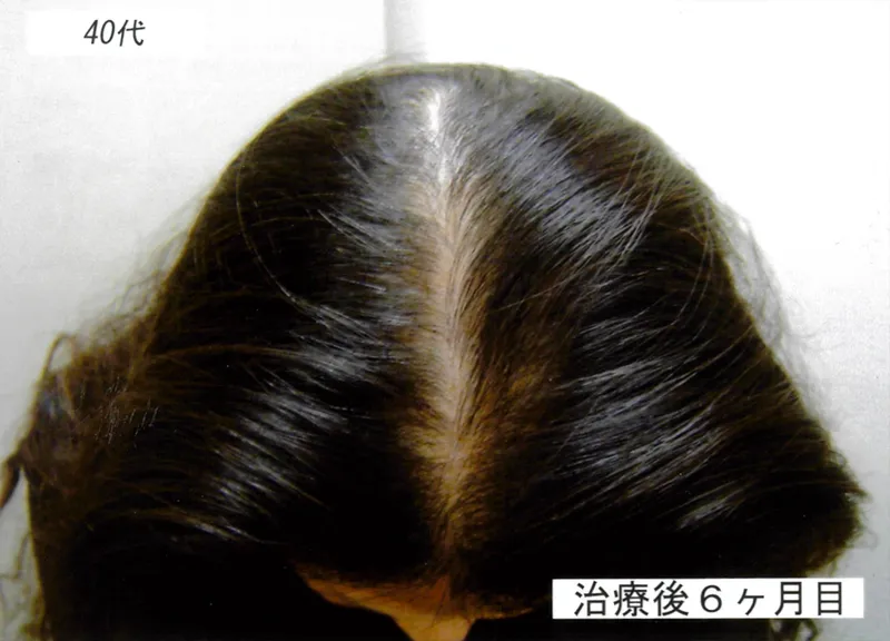 症例6 40代女性 薄毛治療の症例写真 3枚目