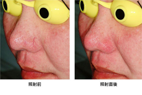 顔面の毛細血管拡張症（YAG/オプションHP）